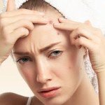 Jerawat Pecah? Tenang, Ini Cara Mengatasinya!