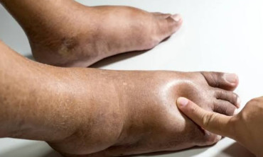 Penyebab kaki bengkak tidak selalu karena Edema